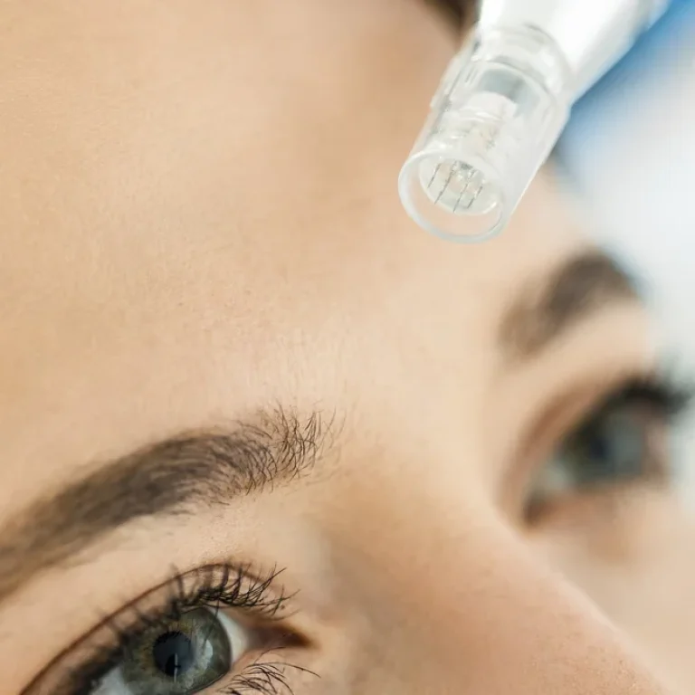 microneedling for the forehead